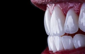 عوارض لمینت دندان و مزایا و معایب آن کدام است