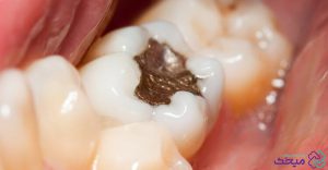 مراحل پر كردن دندان با آمالگام چیست