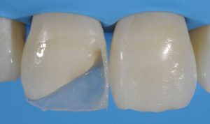 ترمیم کامپوزیت دندان چگونه است؟