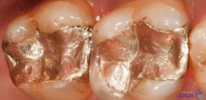 آمالگام یکی از انواع مواد پر کردن دندان است
