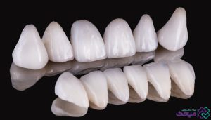 معایب لمینت دندان شامل چه مواردی است