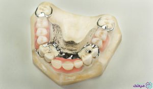 دندان مصنوعی تکه ای برای چه افرادی مناسب است