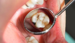 مراحل پر كردن دندان با مواد سفيد چیست