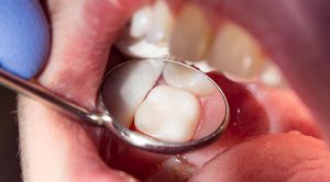 مراقبت بعد از پر کردن دندان چگونه است