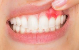 درمان آبسه دندان و لثه چیست