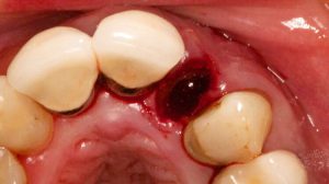 علائم عفونت دندان پس از کشیدن