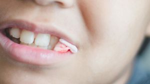 درد بعد از کشیدن دندان چقدر است