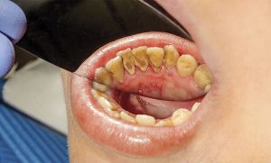 چرا پلاک دندانی ایجاد می‌شود