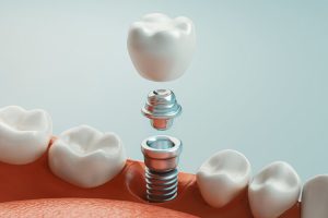 ایمپلنت دندان چگونه است