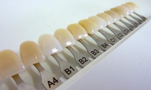 انواع رنگ کامپوزیت دندان