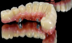 اوردنچر دندان چیست