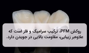 روکش دندان pfm یکی از بهترین انواع روکش دندان است.