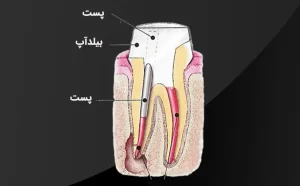 پست دندان یک میله فلزی است.