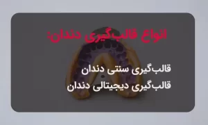 قال گیری دندان به دو روش انجام می‌شود.