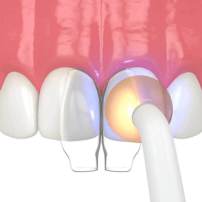 باندینگ دندان (Dental Bonding)