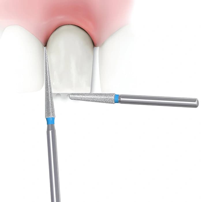 فرم‌دهی مینای دندان (Enameloplasty)
