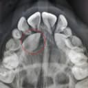 جراحی دندان نیش نهفته