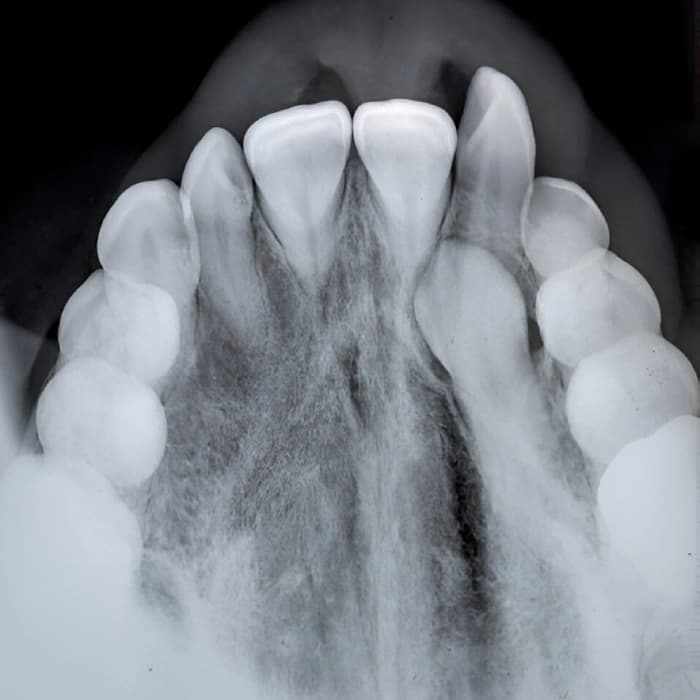 Occlusal (عکس از سطح کامل دندان‌ها)