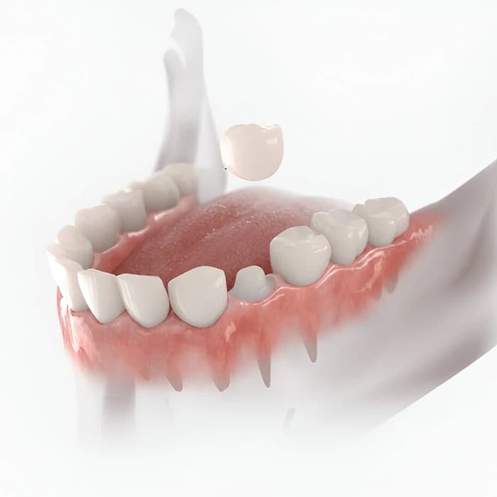 روکش Zirconia