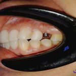 مراحل ایمپلنت دندان | کاشت ایمپلنت دندان در ۷ مرحله