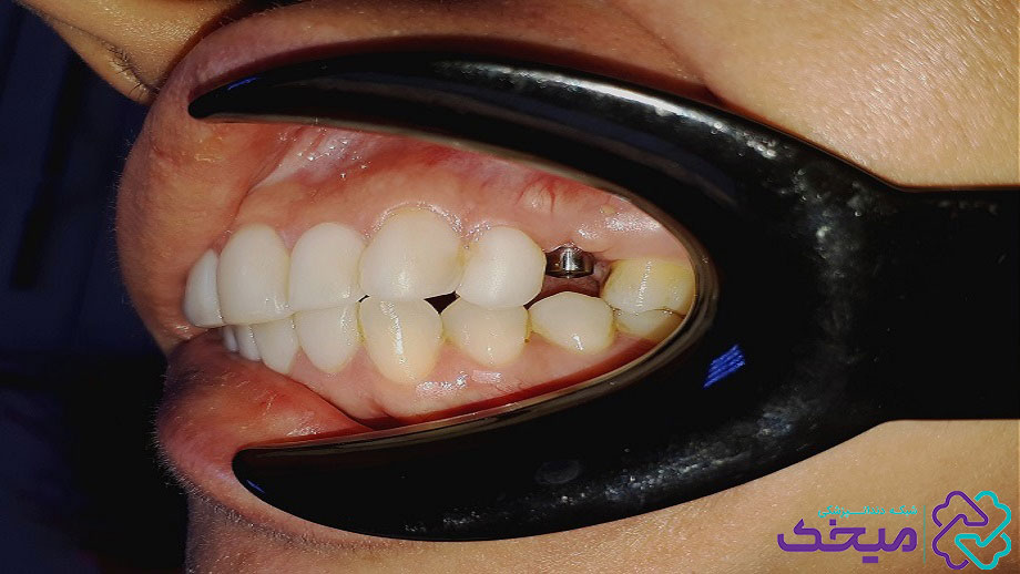 مراحل ایمپلنت دندان