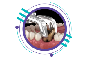 مراحل ایمپلنت دندان - کشیدن دندان یا ریشه نهفته قبلی