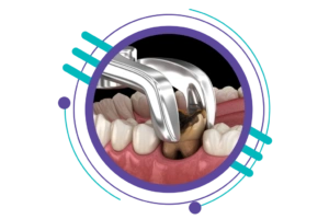 مراحل ایمپلنت دندان - کشیدن دندان یا ریشه نهفته قبلی