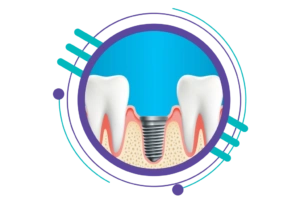 مراحل ایمپلنت دندان - کاشت فیکسچر یا پست