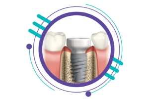 مراحل ایمپلنت دندان - کاشت و جایگذاری هیلینگ یا تاج موقت