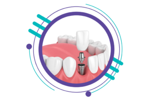مراحل ایمپلنت دندان -قرار دادن تاج دائمی ایمپلنت 