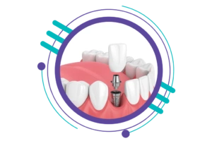 مراحل ایمپلنت دندان -قرار دادن تاج دائمی ایمپلنت 