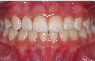 مشاوره ارتودنسی برای تورفتگی دندان های پایین