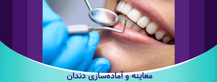معاینه و آماده سازی دندان برای لمینت