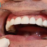 مراحل لمینت دندان و نحوه نصب آن چگونه است؟