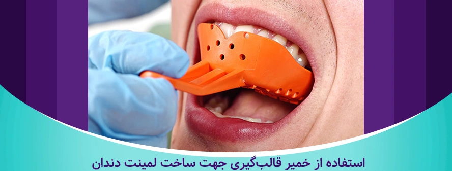 قالب گیری دندان ها در مراحل لمینت دندان