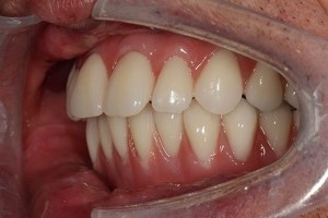 مشاوره ارتودنسی برای بیرون زدگی دندان های بالا