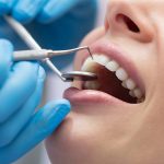 فرق لمینت و کامپوزیت دندان از ۵ جنبه‌ مختلف – کدام بهتر است؟