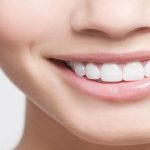 طرح لبخند دندان چیست؟