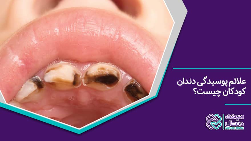 علائم پوسیدگی دندان کودک : حفره‌های سیاه