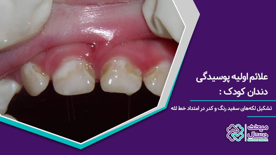 علائم اولیه خرابی دندان کودک