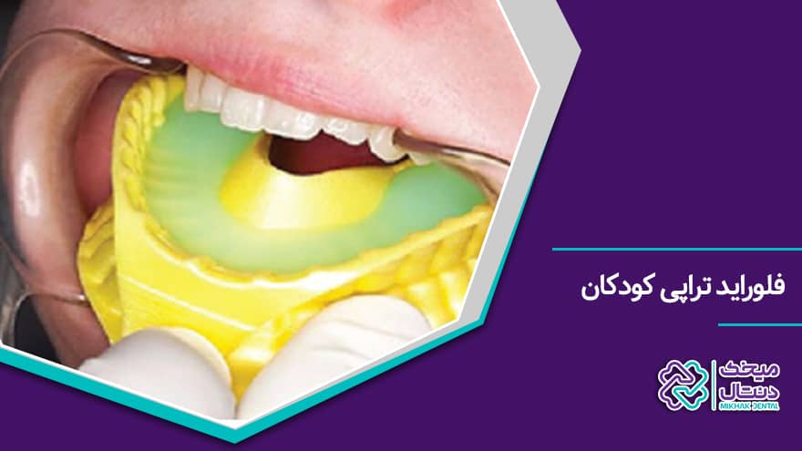جلوگیری از پوسیدگی با فلوراید تراپی دندان کودکان