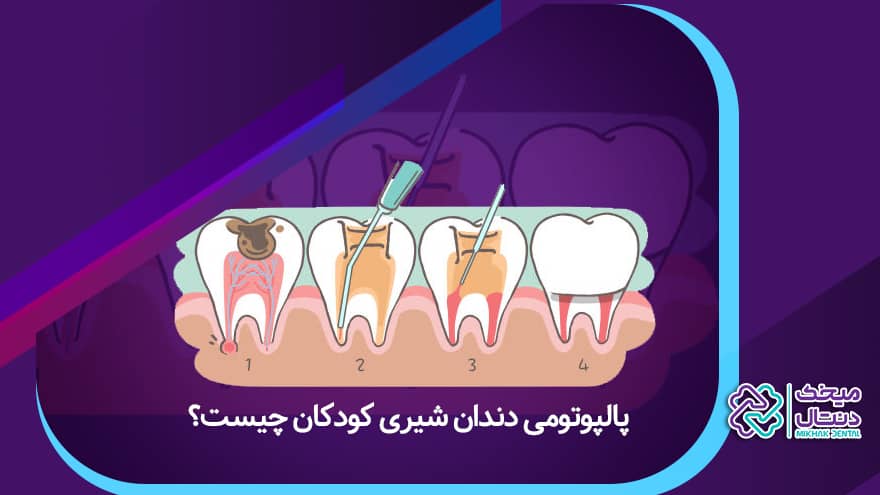 پالپوتومی دندان شیری کودکان چیست؟
