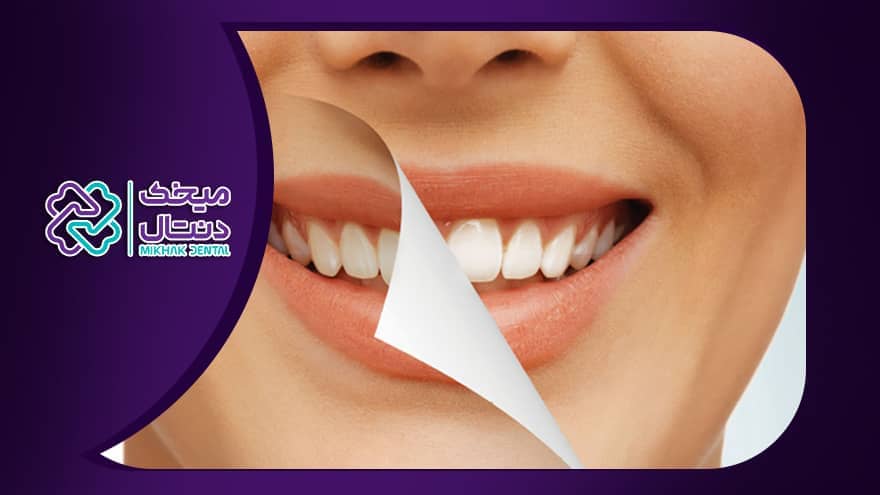 بلیچینگ دندان