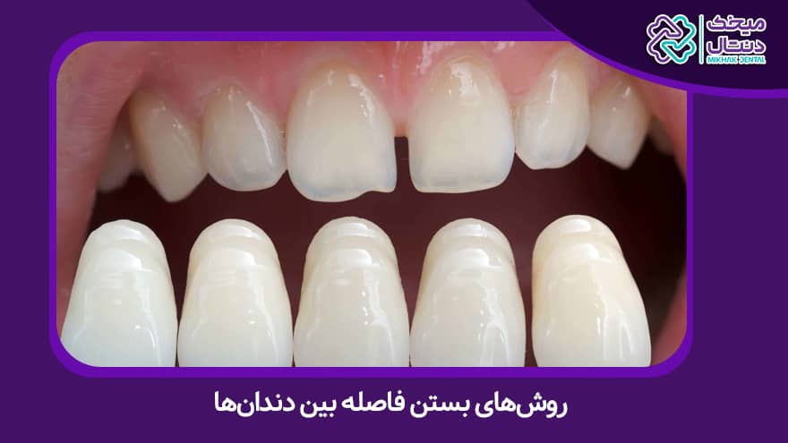 روش های بستن فاصله بین دندانی
