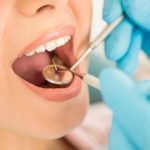 طول عمر کامپوزیت دندان چقدر است؟ ۶ عامل موثر
