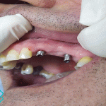 چرا ایمپلنت دندان درد دارد؟