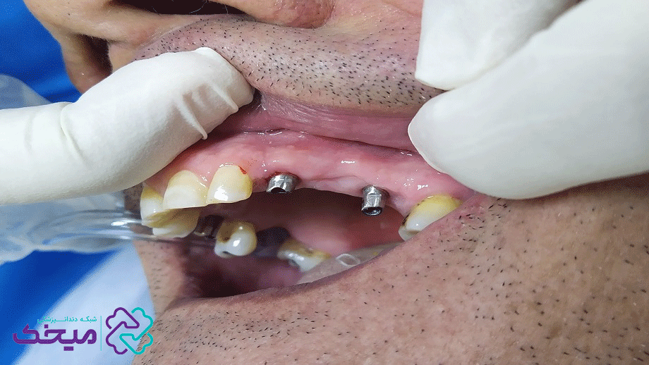 ایمپلنت دندان درد دارد