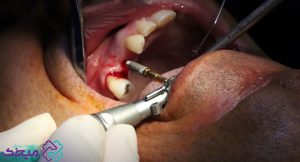 احساس درد در عوارض ایمپلنت دندان