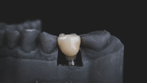 عوارض ایمپلنت دندانی