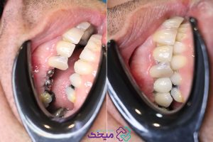 ایمپلنت دندان